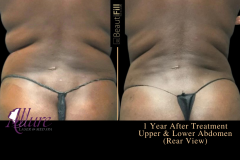 To Crystal Clear - BeautiFill2 - ABS, WAIST, FLANKS