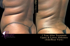 To Crystal Clear - BeautiFill2 - ABS, WAIST, FLANKS