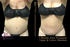 To Crystal Clear - BeautiFill1 - ABS, WAIST, FLANKS