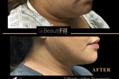 To Crystal Clear BeautiFill - CHIN, NECK, FACE