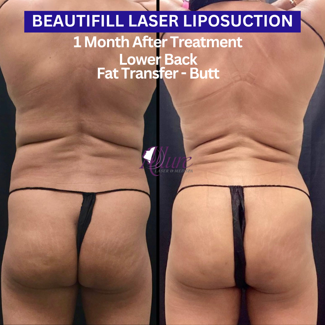 BeautiFill2: ABS/WAIST/FLANKS (Front & Rear) - Lower Back, Fat Transfer-Butt