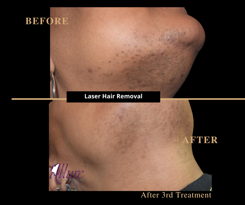Laser Hair Removal Patient