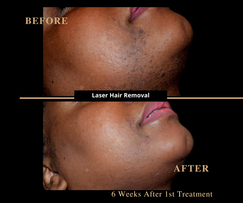 Laser Hair Removal Patient