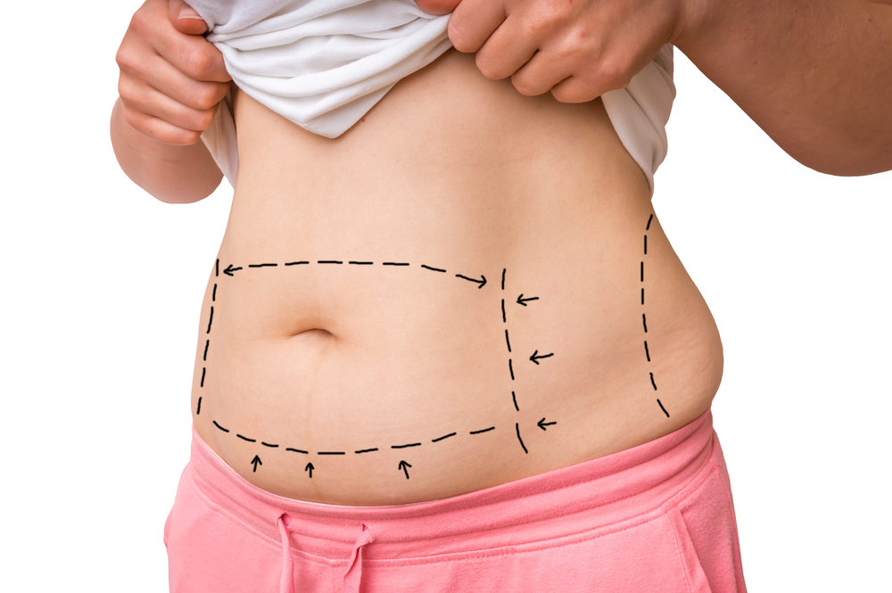 Laser Liposuction: What Is It and How Does It Work?