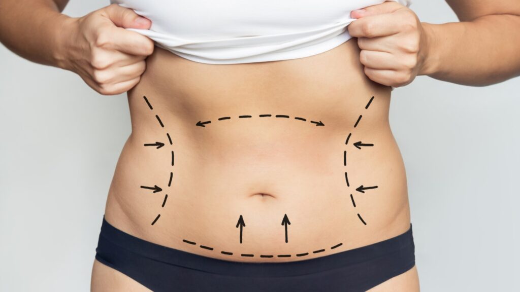 The Road to Recovery: What to Expect After Your Laser Liposuction Procedure | Allure Laser & Med Spa